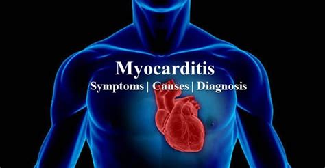 Myocarditis Causes Symptoms And Diagnosis Dr Sarat