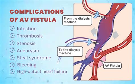 What Are Complications Of Av Fistula