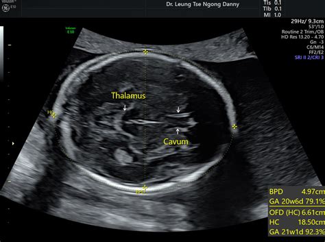 Fetal Biometry Hkog Info