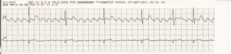 EKG Rhythm Strips Slow Rhythms 2