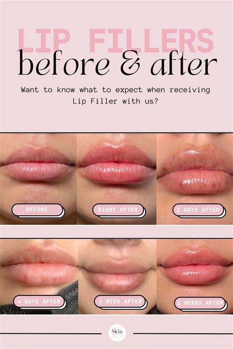 Explore Our Lip Fillers Before And After And Be Inspired By The