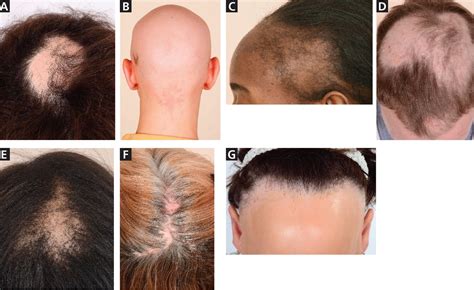 Male And Female Pattern Hair Loss Treatable And Worth Treating