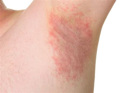 What Are Common Symptoms And Treatments For Fungal Skin Infections