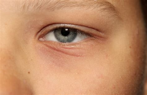 Eczema Rash On Eyelid