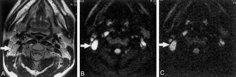 Discrimination Of Metastatic Cervical Lymph Nodes With Diffusion
