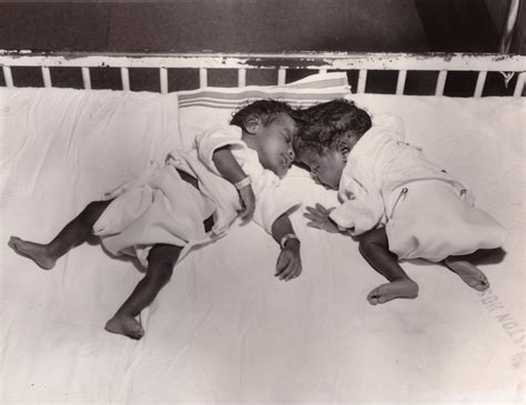 A Memphis Medical Miracle The Miller Conjoined Twins Memphis Magazine