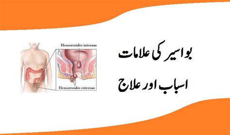 خونی اور ریحی بواسیر اسباب علامات اور علاج Yes Urdu Overseas Urdu