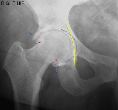 Imaging Of Femoral Acetabular Impingement Syndrome St