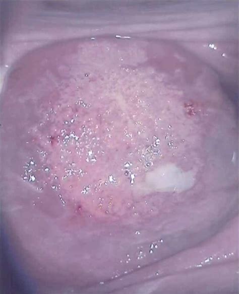 Cervical Ectropion Cervix