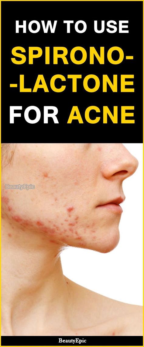 How To Use Spironolactone For Acne Epsomsaltacne Acne