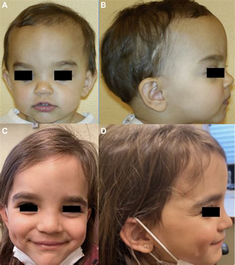Pictures Of A Patient Presenting A Non Syndromic Anterior Plagiocephaly