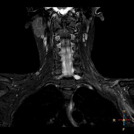 Grading Of Brachial Plexus Injuries Radiology Reference Article My Xxx Hot Girl