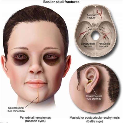 Why Raccoon Eyes Appear In Basal Skull Fracture Traumatology Part