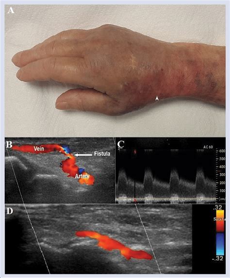 A Hematoma And Edema Of The Dorsal Part Of The Hand Presented The