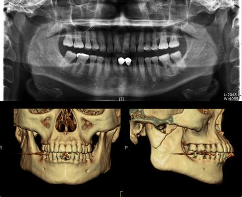 Preoperative Panoramic Radiograph Above And 3d Ct Frontal And Right
