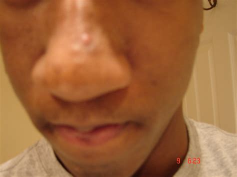 How To Get Rid Of These Bumps On My Nose General Acne Discussion Free