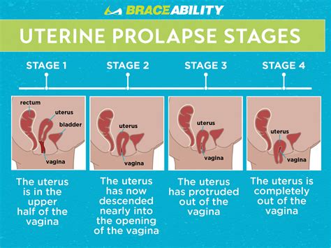 Download 41 Uterine Prolapse Stages Images