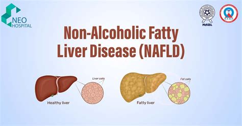 Non Alcoholic Fatty Liver Disease Nafld