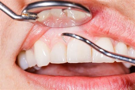 Importance Of Regular Dental Checkups Simply Dental Chatswood
