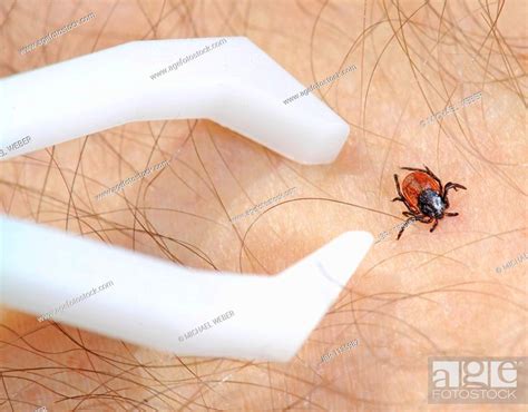 Tick Tweezer And Deer Tick Or Black Legged Tick Ixodes Scapularis Say