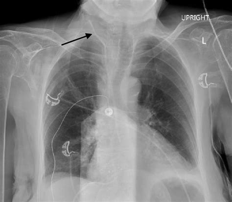 Cureus Subclavian Artery Injury Following Central Venous Catheter The