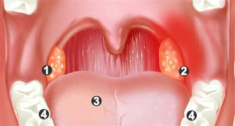 Mandelentzündung Tonsillitis Apotheken Umschau