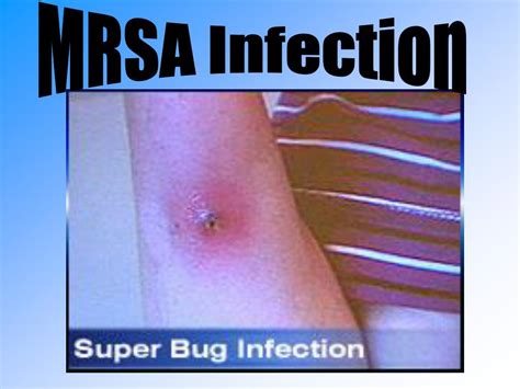 Ppt Mrsa Infection Powerpoint Presentation Free Download Id5474495
