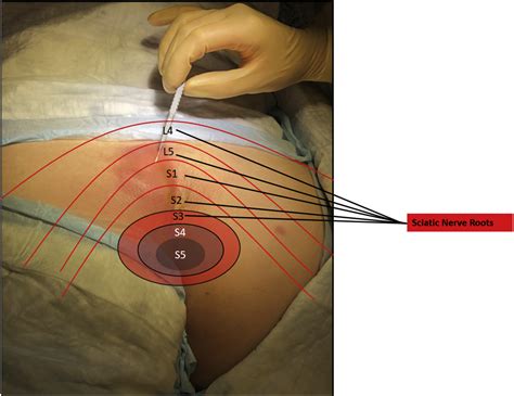 Ultrasound Guided Transgluteal Sciatic Nerve Block For Gluteal Procedural Analgesia Journal Of