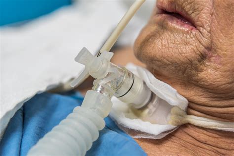 Comparing Tracheostomy Tube Decannulation Protocols In Critically Ill Patients Pulmonology Advisor