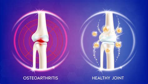 Everything You Need To Know About Osteoarthritis And How To Combat It