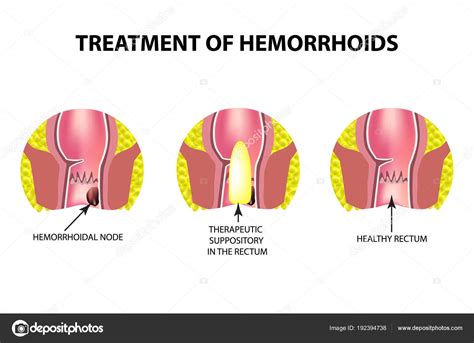 treatment of hemorrhoids with suppositories infographics vector illustration on isolated