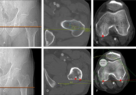 A Validation Study For Estimation Of Femoral Anteversion Using The