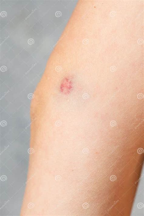Big Bruise On The Girland X27s Skin Close Up Skin Hematoma Purple