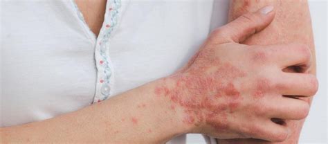 Psoriasis Tied To Higher Risk For Nonalcoholic Fatty Liver Disease My