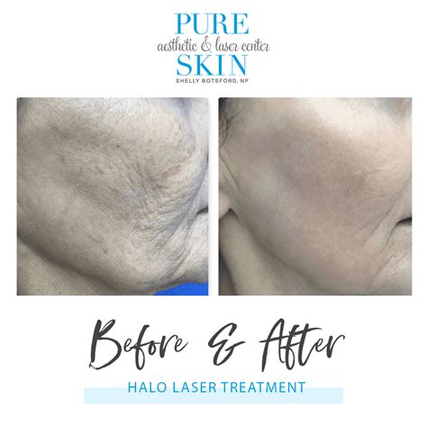 Monthly Specials Bismarck Nd Pure Skin Aesthetic And Laser Center
