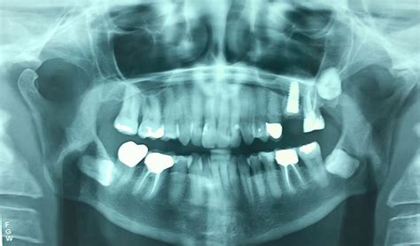 Sinus Lift Dentofacial