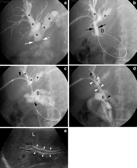 Percutaneous Treatment Of A Benign Stricture Of The Common Bile Duct By
