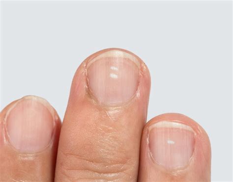 White Spots On Nails Causes Prevention And Treatment Medical News