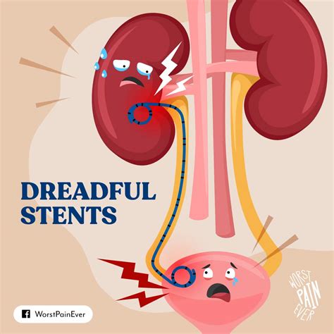 Does It Hurt To Have A Kidney Stent Removed