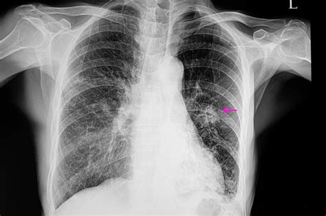 World Pneumonia Day Little Known Facts And Figures About This Lung