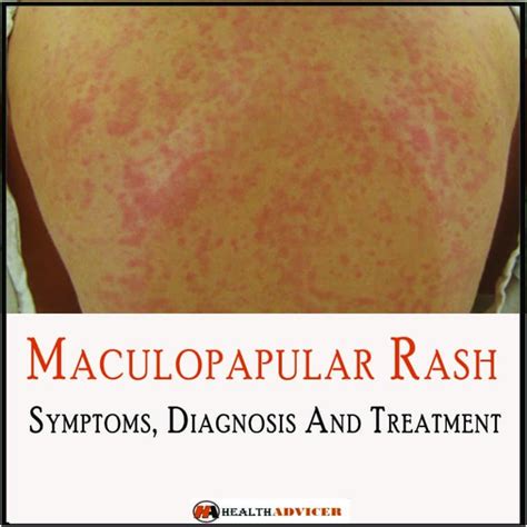 Maculopapular Rash Causes Symptoms And Treatment