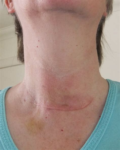 Partial Thyroidectomy Before And After Photos Partial Thyroidectomy