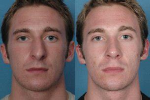 After surgery on the nose is applied a plaster cast, by means of which bone and cartilage fragments are fixed in the new position. Rhinoplasty Patient Pictures, Champaign | Male Nose Job ...