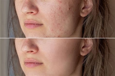 Premium Photo A Young Womans Face Before And After Acne Treatment On