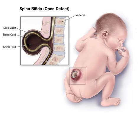 Spina Bifida Causes Types Symptoms And Treatment Healthtian