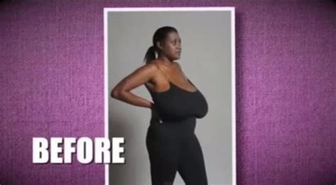 Woman With 36nnn Breasts Has Them Removed Because She Cant Run Or