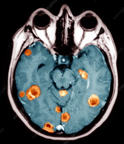 Brain Cancers Mri Scan Stock Image M1340471 Science Photo Library