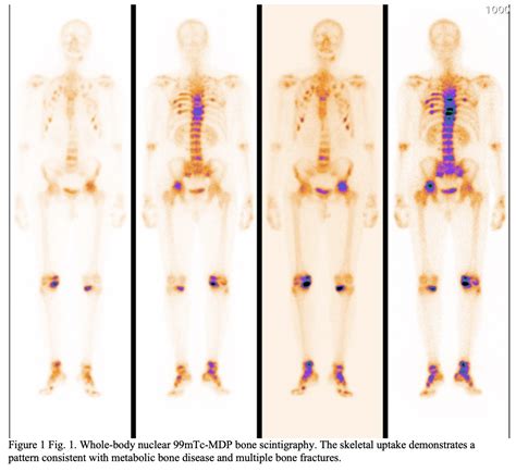 Whole Body Bone Scintigraphy Journal Of Medical Sciences