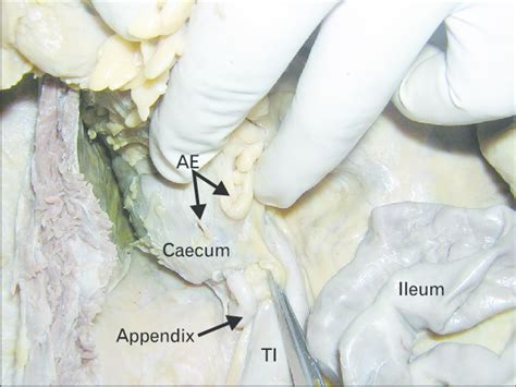 Closer View Of The Cecum And Appendix Note The Vertical Course Of The