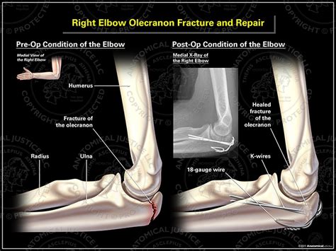 Right Elbow Olecranon Fracture And Repair